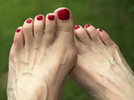Bunions