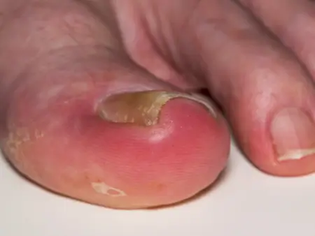 Ingrown Toenail